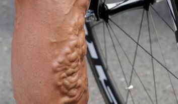 varicose veins in cyclists